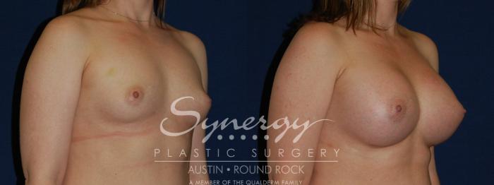 Before & After Breast Augmentation Case 143 View #3 View in Austin, TX