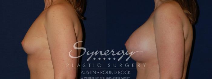 Before & After Breast Augmentation Case 143 View #4 View in Austin, TX