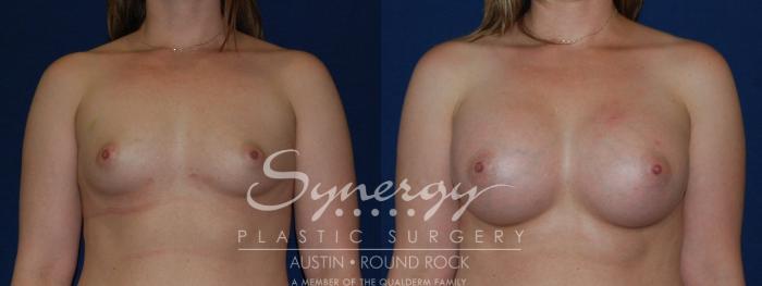 Before & After Breast Augmentation Case 143 View #5 View in Austin, TX