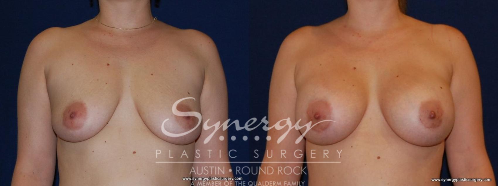 Before & After Breast Augmentation Case 151 View #1 View in Austin, TX