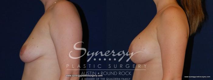 Before & After Breast Augmentation Case 151 View #3 View in Austin, TX