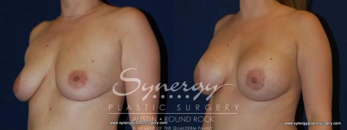 Before & After Breast Augmentation Case 151 View #4 View in Austin, TX