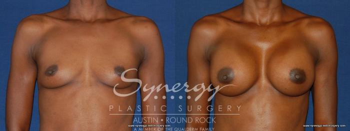Before & After Breast Augmentation Case 165 View #1 View in Austin, TX