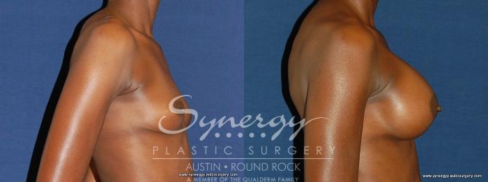 Before & After Breast Augmentation Case 165 View #2 View in Austin, TX