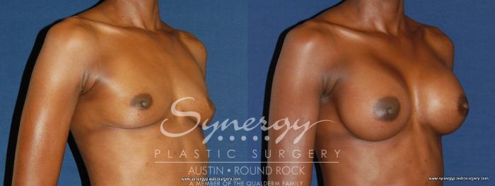 Before & After Breast Augmentation Case 165 View #3 View in Austin, TX