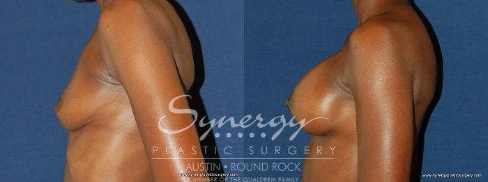 Before & After Breast Augmentation Case 165 View #4 View in Austin, TX