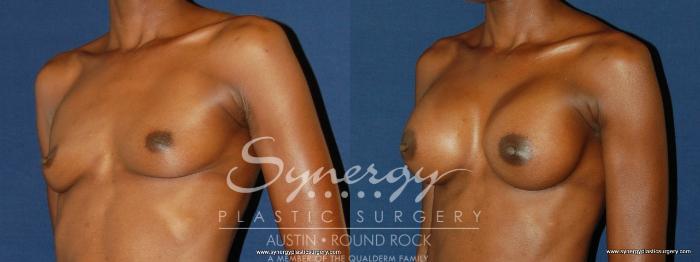 Before & After Breast Augmentation Case 165 View #5 View in Austin, TX
