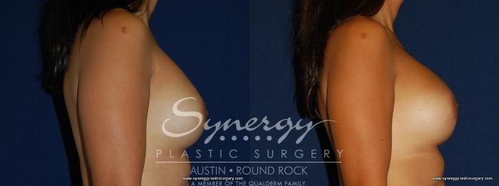 Before & After Breast Augmentation Case 166 View #2 View in Austin, TX