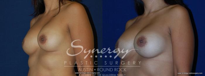 Before & After Breast Augmentation Case 166 View #3 View in Austin, TX