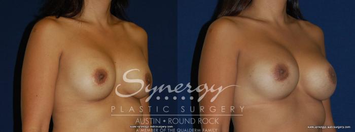 Before & After Breast Augmentation Case 166 View #5 View in Austin, TX