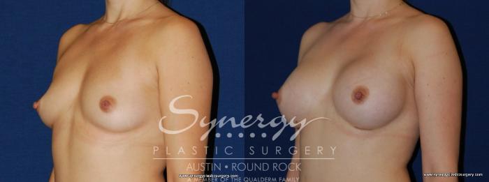 Before & After Breast Augmentation Case 170 View #1 View in Austin, TX