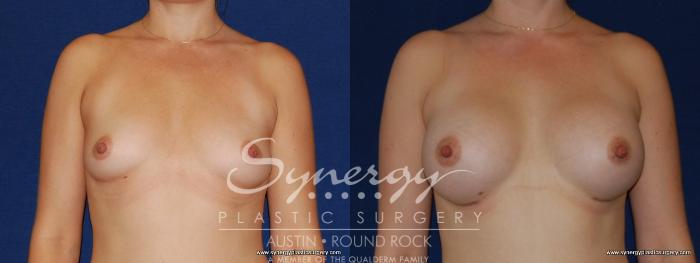 Before & After Breast Augmentation Case 170 View #2 View in Austin, TX