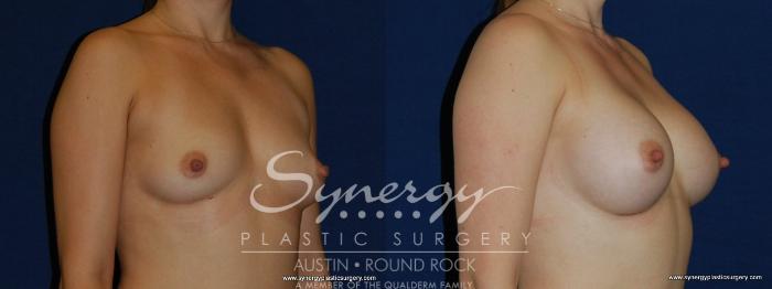 Before & After Breast Augmentation Case 170 View #3 View in Austin, TX