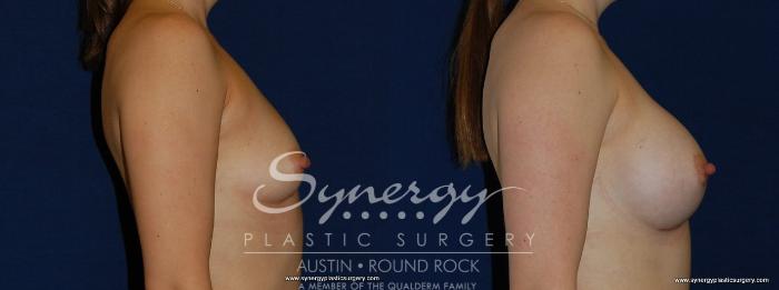 Before & After Breast Augmentation Case 170 View #4 View in Austin, TX