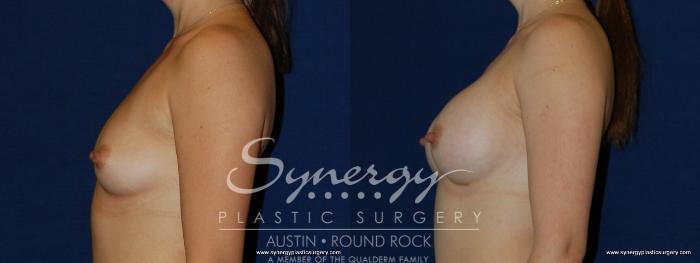 Before & After Breast Augmentation Case 170 View #5 View in Austin, TX