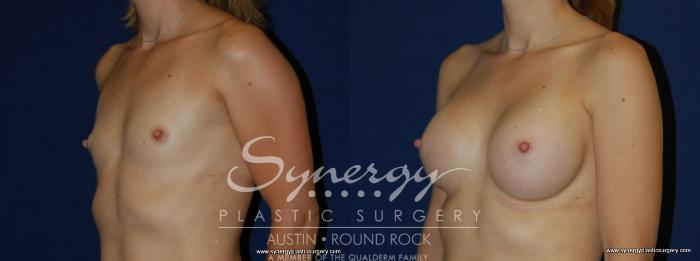Before & After Breast Augmentation Case 171 View #1 View in Austin, TX