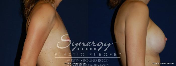 Before & After Breast Augmentation Case 171 View #2 View in Austin, TX