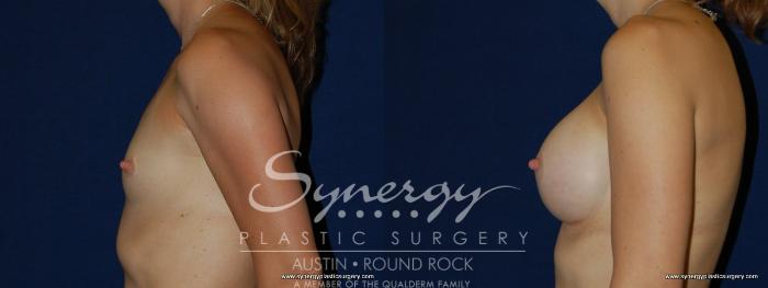 Before & After Breast Augmentation Case 171 View #3 View in Austin, TX