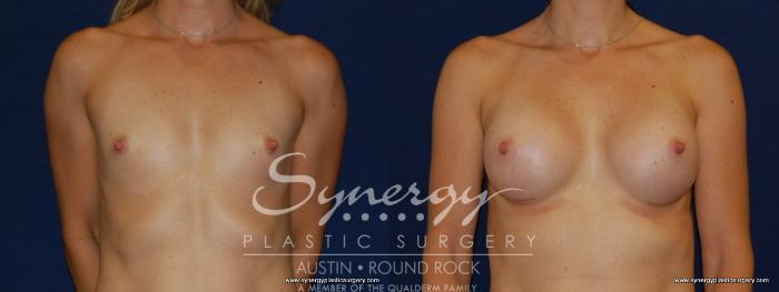 Before & After Breast Augmentation Case 171 View #4 View in Austin, TX