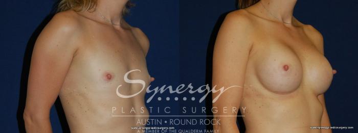Before & After Breast Augmentation Case 171 View #5 View in Austin, TX