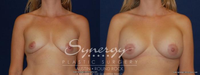 Before & After Breast Augmentation Case 181 View #1 View in Austin, TX