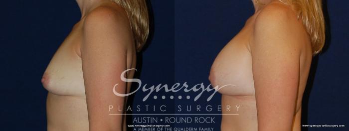 Before & After Breast Augmentation Case 181 View #2 View in Austin, TX