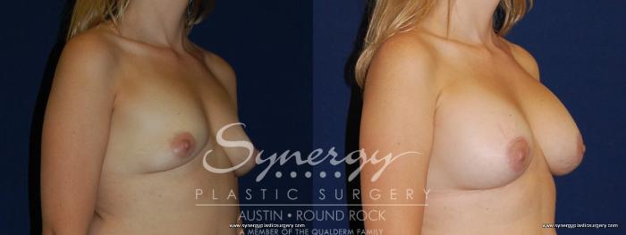 Before & After Breast Augmentation Case 181 View #4 View in Austin, TX