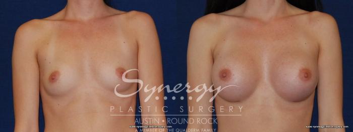 Before & After Breast Augmentation Case 185 View #1 View in Austin, TX