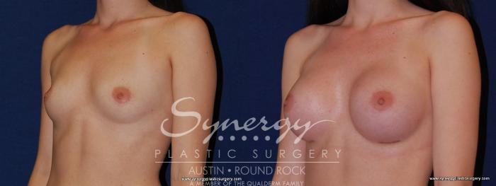 Before & After Breast Augmentation Case 185 View #2 View in Austin, TX