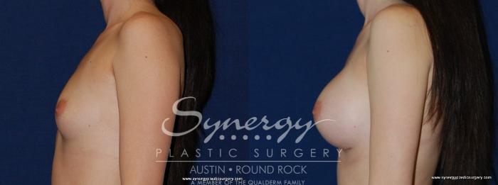 Before & After Breast Augmentation Case 185 View #3 View in Austin, TX