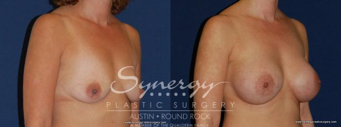 Before & After Breast Augmentation Case 187 View #1 View in Austin, TX