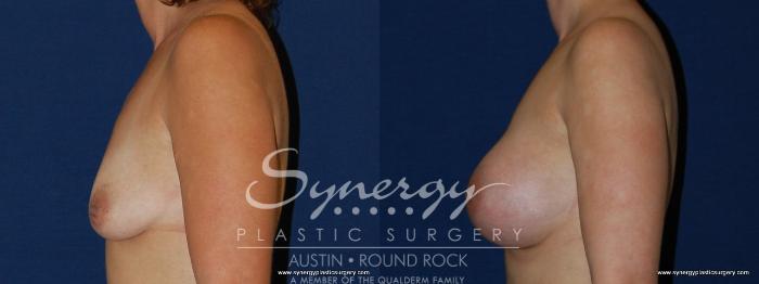 Before & After Breast Augmentation Case 187 View #2 View in Austin, TX