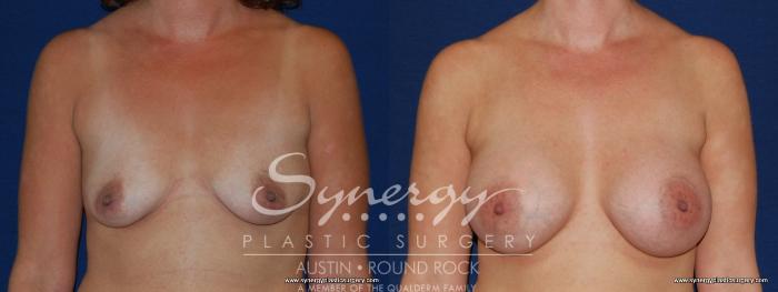 Before & After Breast Augmentation Case 187 View #3 View in Austin, TX