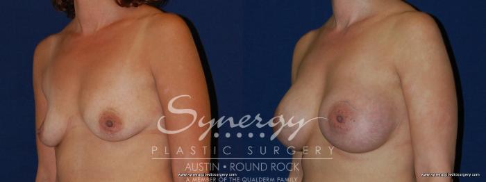 Before & After Breast Augmentation Case 187 View #5 View in Austin, TX