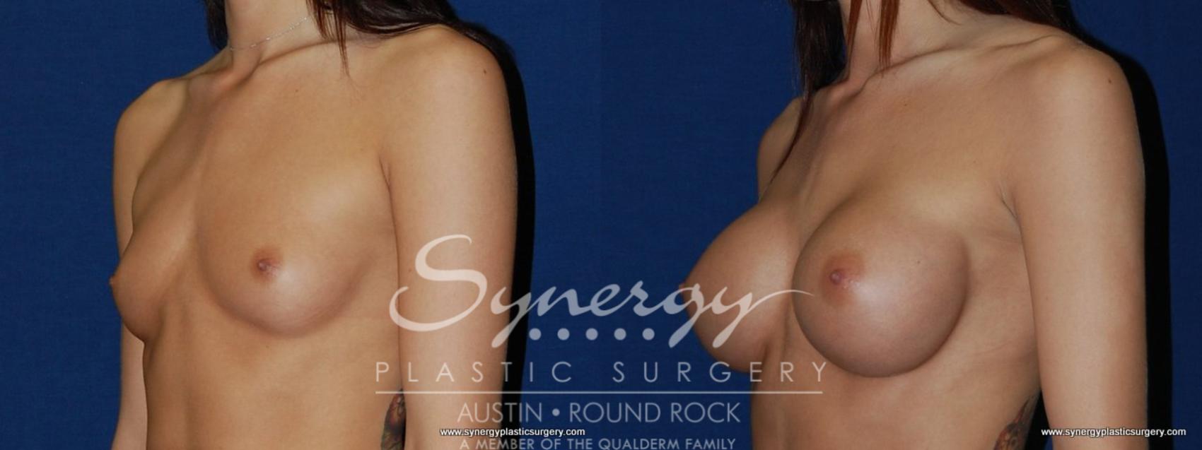 Before & After Breast Augmentation Case 197 View #1 View in Austin, TX