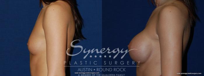 Before & After Breast Augmentation Case 197 View #2 View in Austin, TX