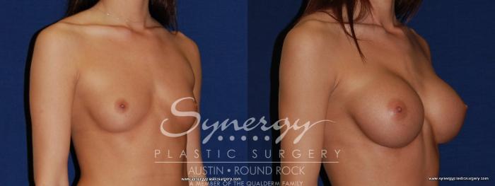 Before & After Breast Augmentation Case 197 View #3 View in Austin, TX
