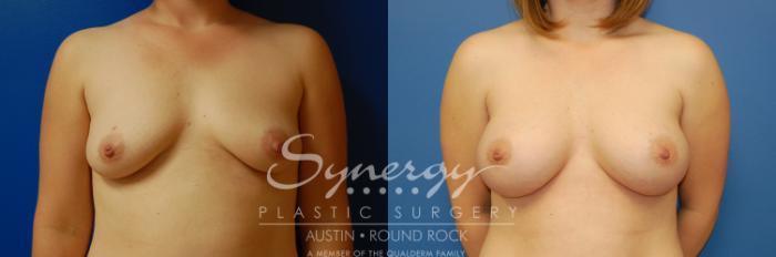 Before & After Breast Augmentation Case 2 View #1 View in Austin, TX