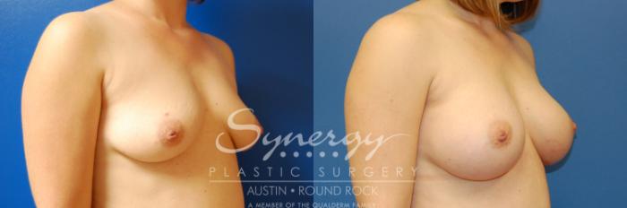 Before & After Breast Augmentation Case 2 View #2 View in Austin, TX
