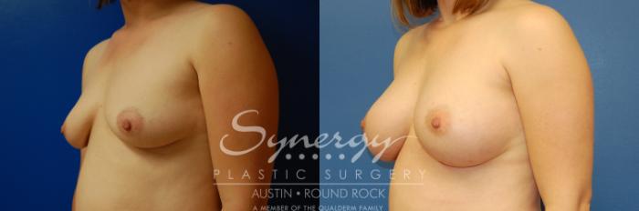 Before & After Breast Augmentation Case 2 View #3 View in Austin, TX
