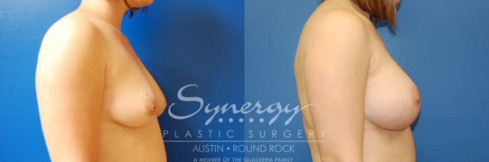 Before & After Breast Augmentation Case 2 View #4 View in Austin, TX