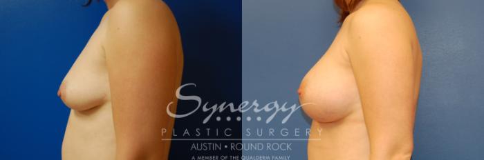 Before & After Breast Augmentation Case 2 View #5 View in Austin, TX