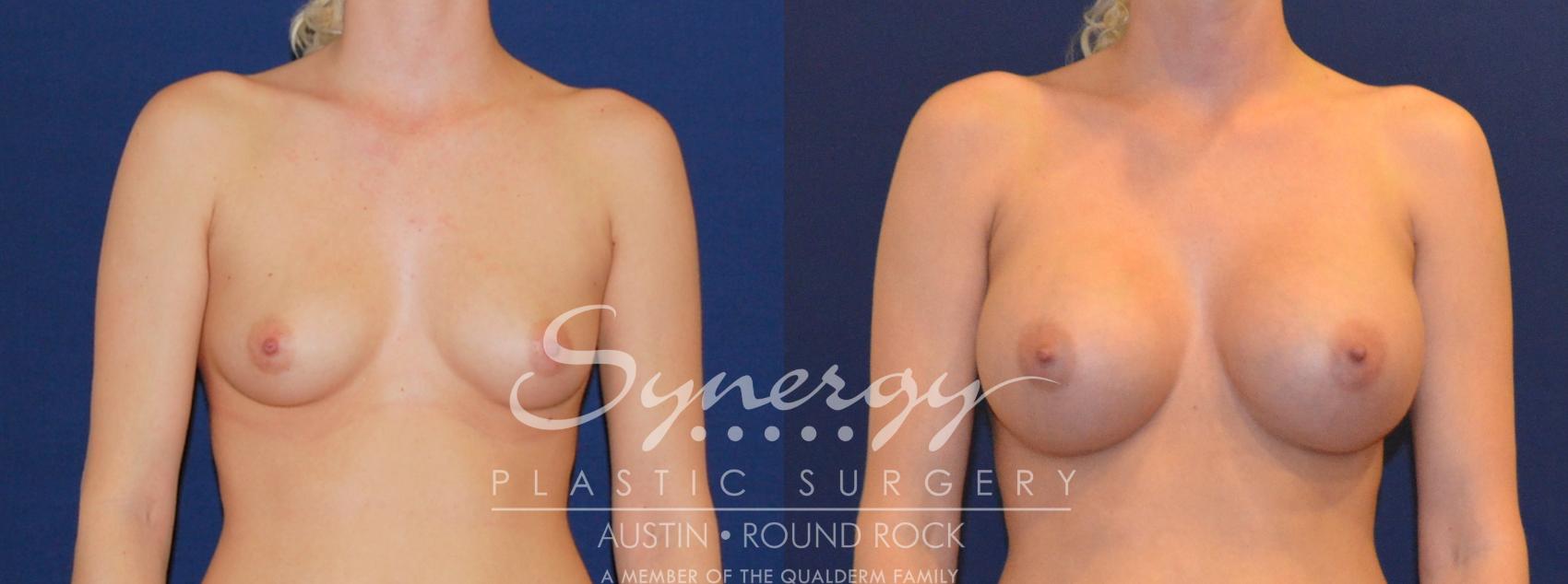 Before & After Breast Augmentation Case 204 View #1 View in Round Rock, TX