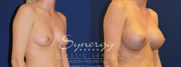 Before & After Breast Augmentation Case 204 View #2 View in Austin, TX