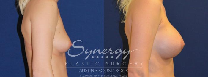 Before & After Breast Augmentation Case 204 View #3 View in Austin, TX