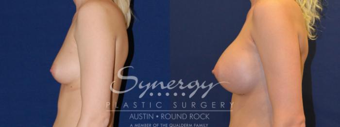 Before & After Breast Augmentation Case 204 View #4 View in Austin, TX