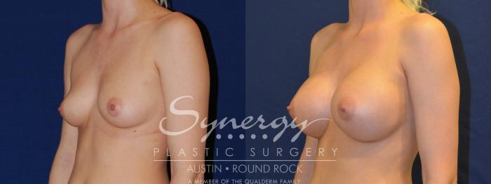 Before & After Breast Augmentation Case 204 View #5 View in Austin, TX