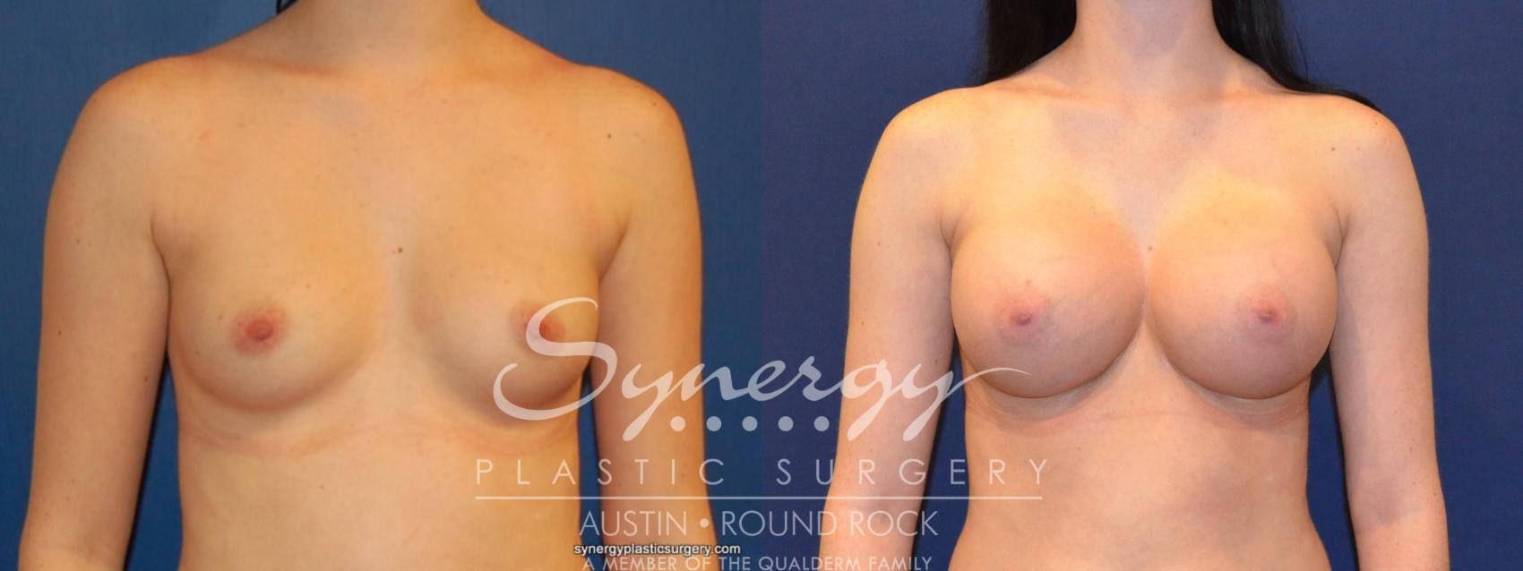 Before & After Breast Augmentation Case 207 View #1 View in Round Rock, TX