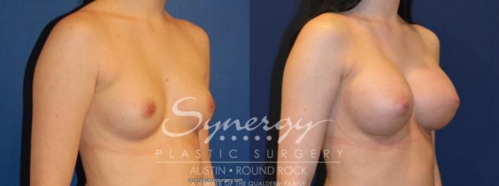 Before & After Breast Augmentation Case 207 View #2 View in Austin, TX