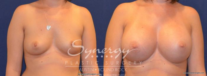 Before & After Breast Augmentation Case 211 View #1 View in Austin, TX
